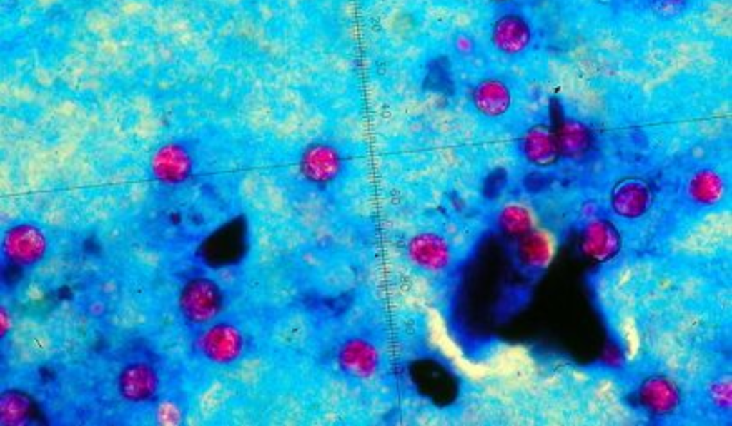 Cyclospora Parasite Outbreak