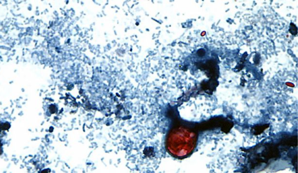 Cyclospora Parasite Outbreak