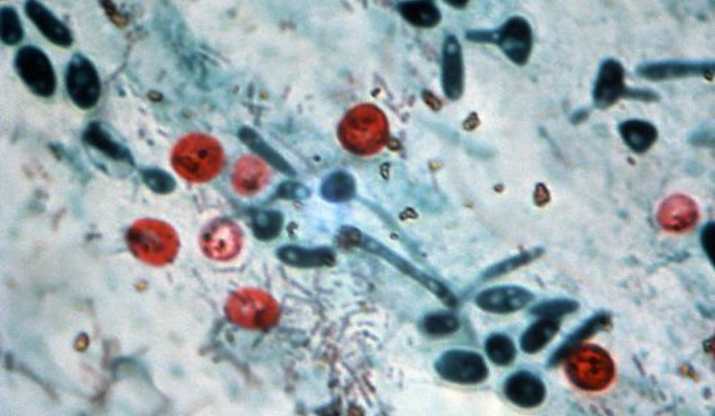 Cyclospora Parasite Outbreak