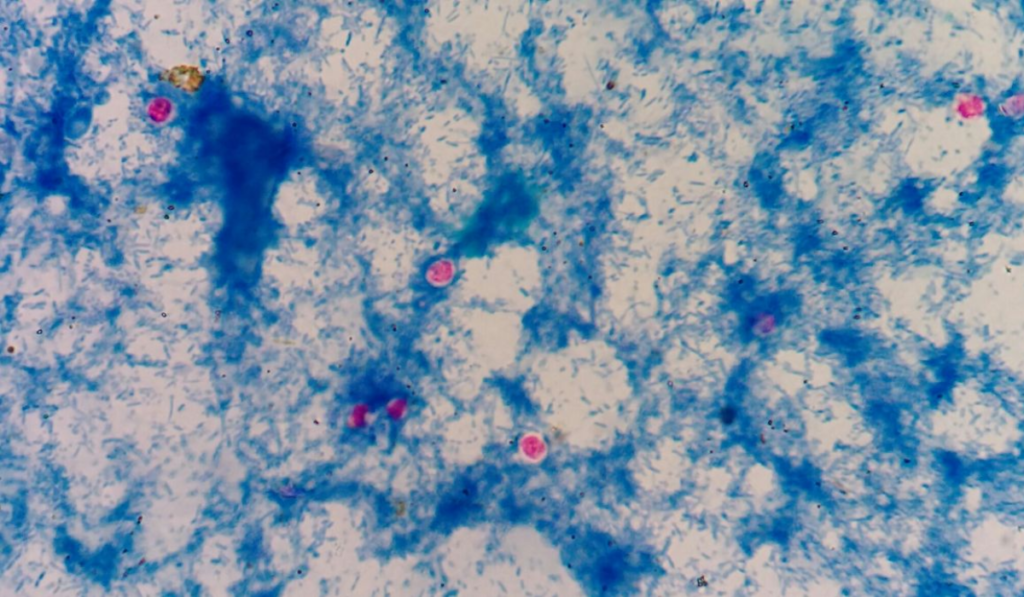 Cyclospora Parasite Outbreak
