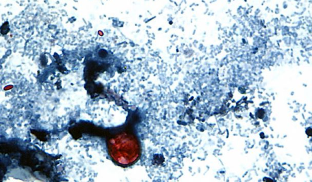 Cyclospora Parasite Outbreak