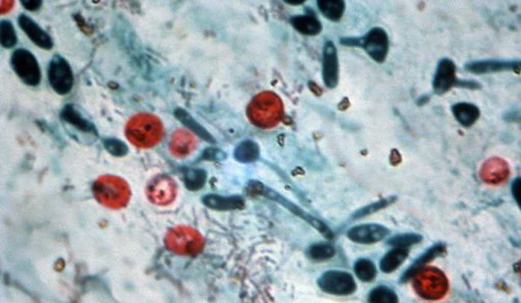 Cyclospora Parasite Outbreak