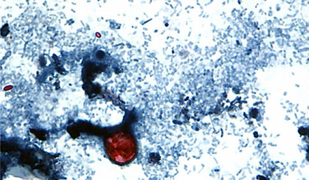 Explosive Diarrhea Outbreak